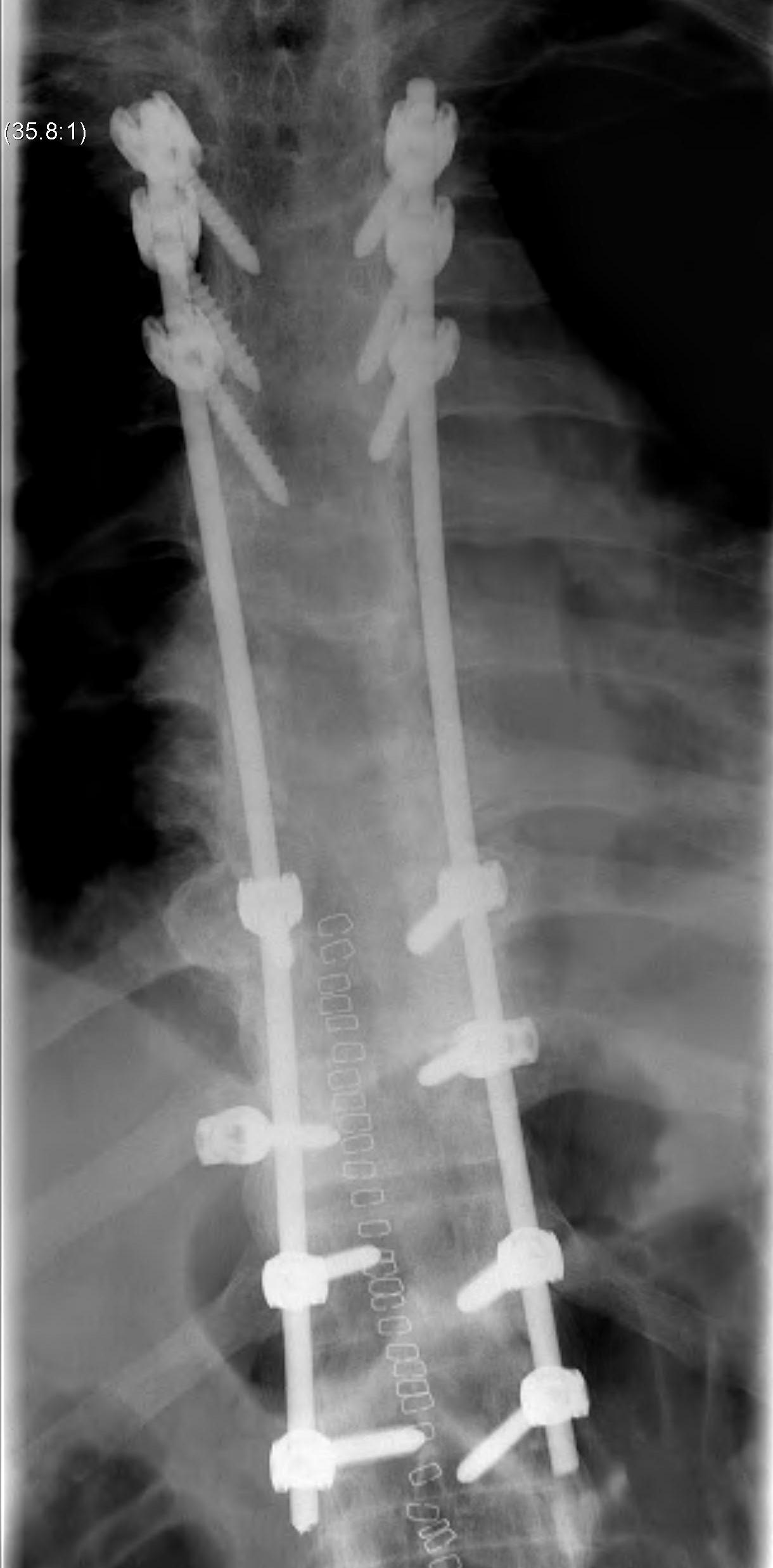 Ankylosing Spondylitis Thoracic Fracture Stabilisation AP